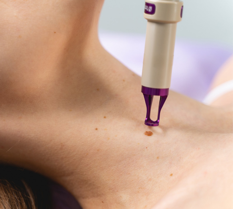 Mole Removal